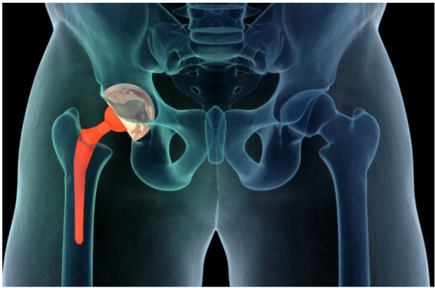 Hip Replacement