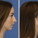 chin implant