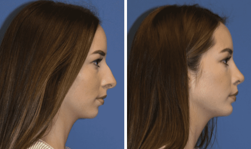 chin implant