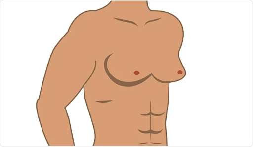 breast reduction