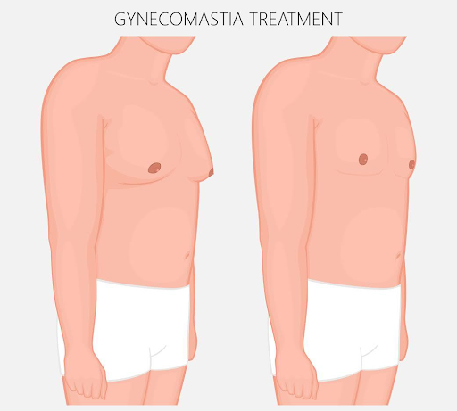 Breast Reduction
