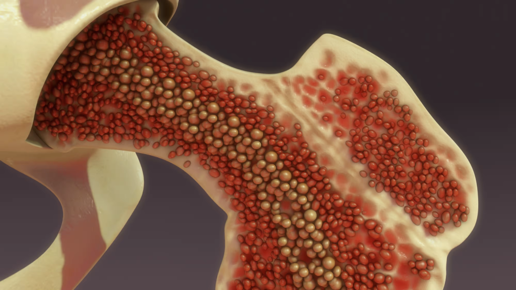 Bone Marrow Transplant in India for Foreigners